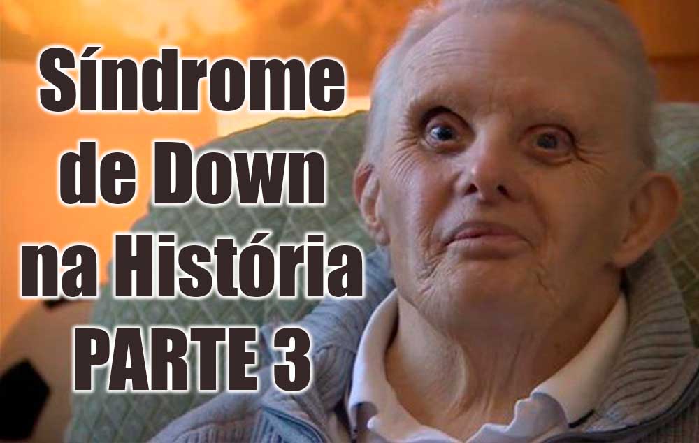 Síndrome de Down na História – parte 3