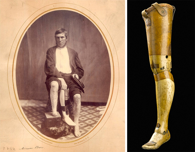 History of War and Prosthetics (4)